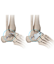 Minimally Invasive Ankle Ligament Repair