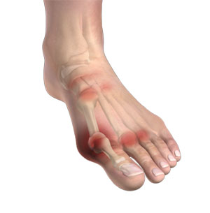 Arthritis of Foot