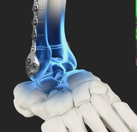 Syndesmosis Stabilization Surgery using Tightrope Fixation