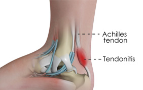 mild achilles pain