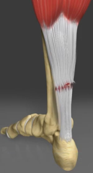 Achilles Tendon