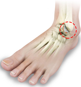 Ankle Arthritis