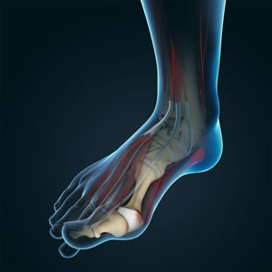 Bunions (Hallux Valgus)