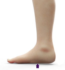 Flatfoot – Paediatric