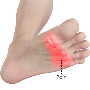 Metatarsalgia(forefoot pain)