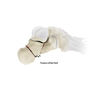 Calcaneal Fractures (Heel Fractures)