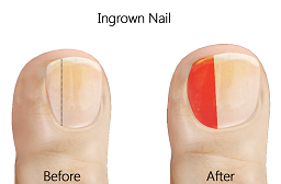 Ingrown Toenail