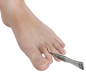 Lesser Toe Correction Surgery