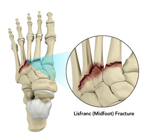 Lisfranc Injury