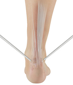 Minimally Invasive Achilles Repair
