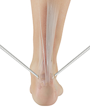Minimally Invasive Achilles Repair