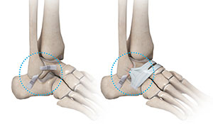 Minimally Invasive Ankle Ligament Repair