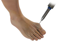 Minimally Invasive Bunion Surgery