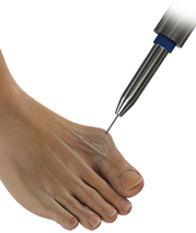 Minimally Invasive Bunion Surgery