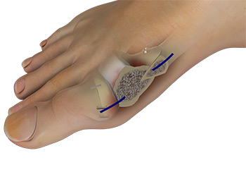 Minimally Invasive Chevron and Akin (MICA) procedure for bunions