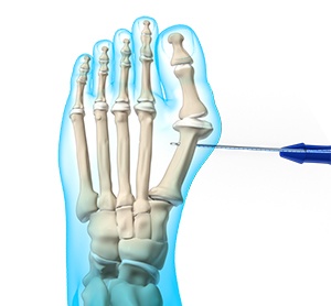 Minimally Invasive Foot Surgery