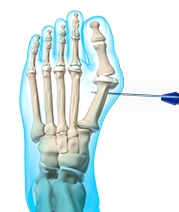 Minimally Invasive Foot Surgery