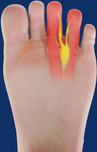 Morton's Neuroma Treatment Penrith | Foot Pain Blue Mountains | Blacktown