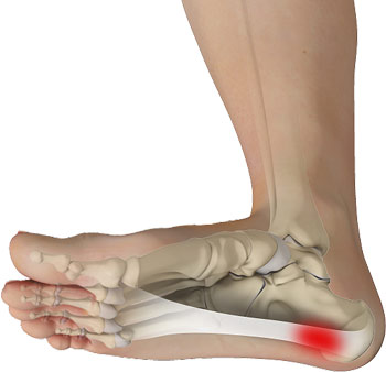 Plantar Fasciitis, One Ashford Hospital, One Healthcare