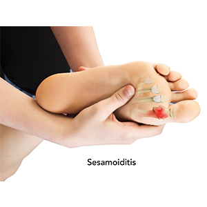 Sesamoiditis