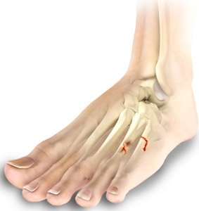 Toe and Fore Foot Fractures