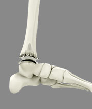 Ankle Joint Replacement