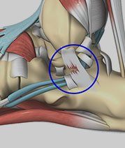 Ankle Ligament Reconstruction