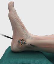 Ankle Sprain Surgical Intervention 