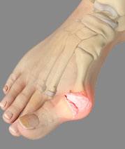 Bunion Surgery