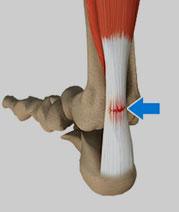 Surgery for a Torn Achilles Tendon